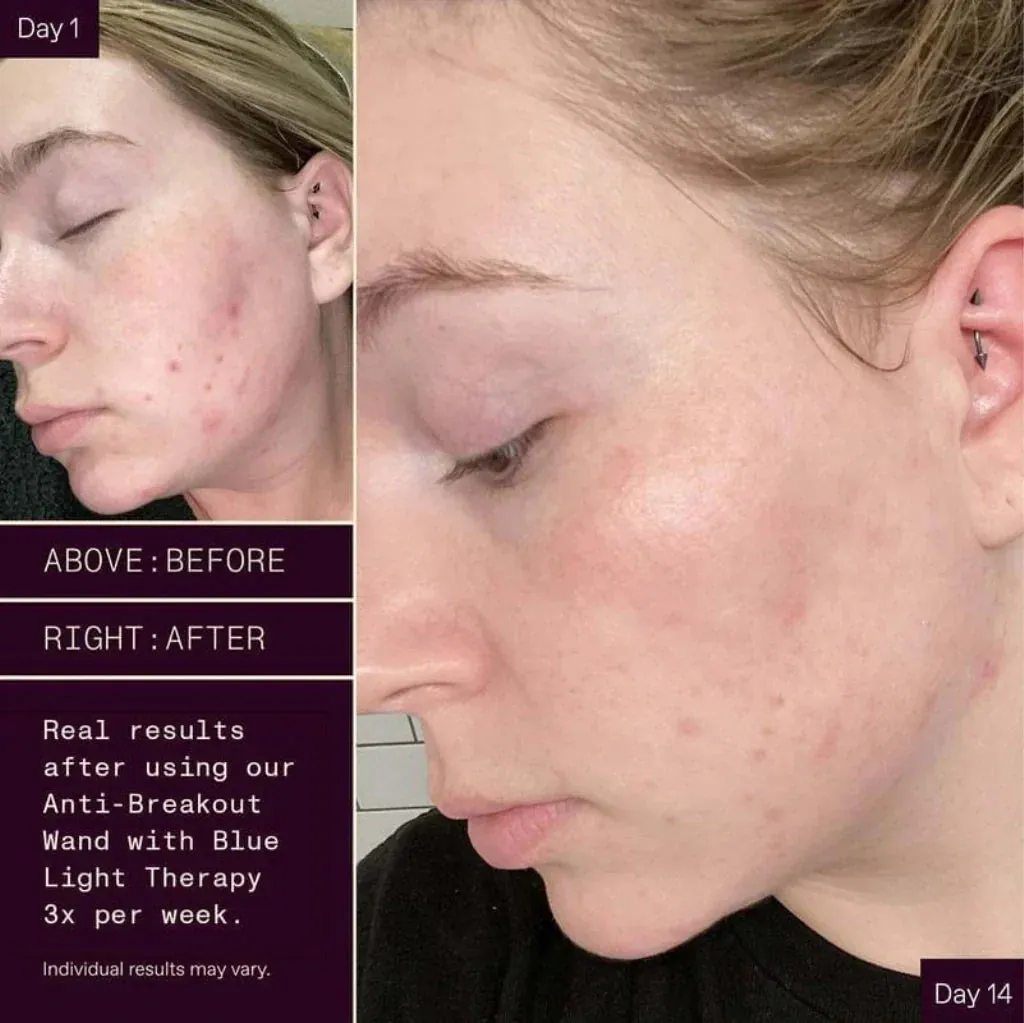 Acne Away Magic Light Wand