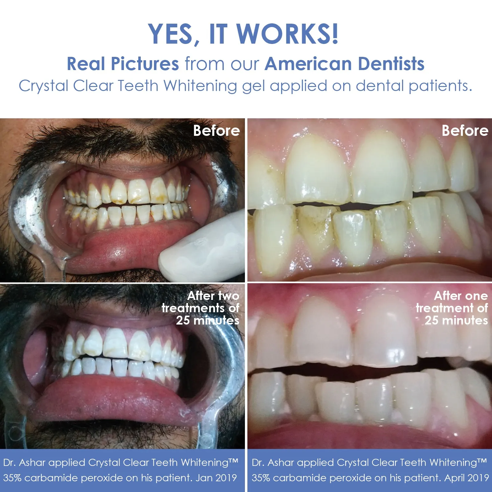 Crystal Clear Teeth Whitening Gel Refill - 10 Pack