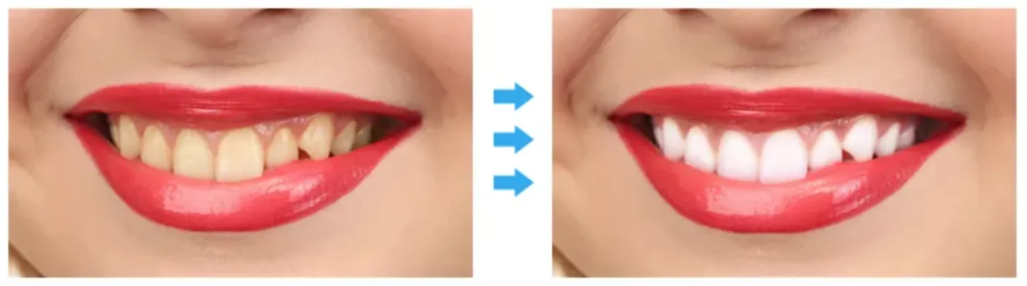 Gel Teeth Whitening Refill Pen
